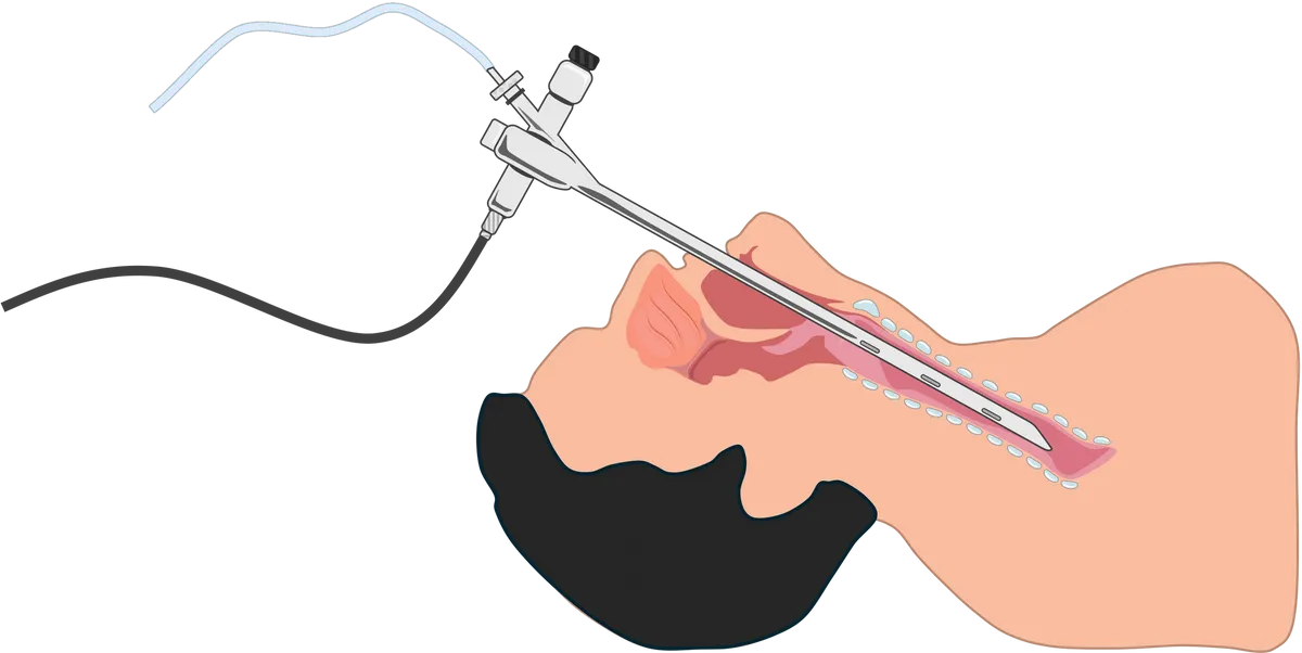 BRONCHOSCOPY